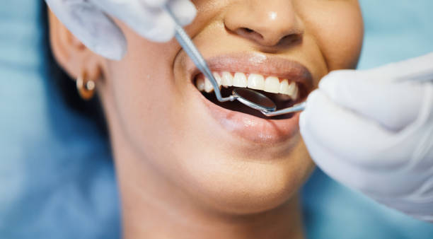 Best Chipped Tooth Repair Near Me  in Iowa, LA